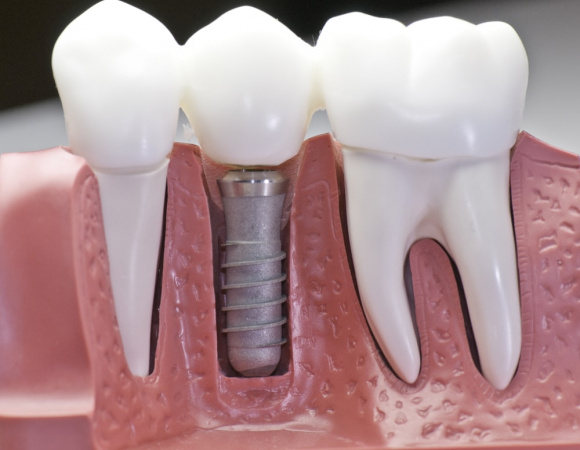 имплантация зубов отзывы зубов